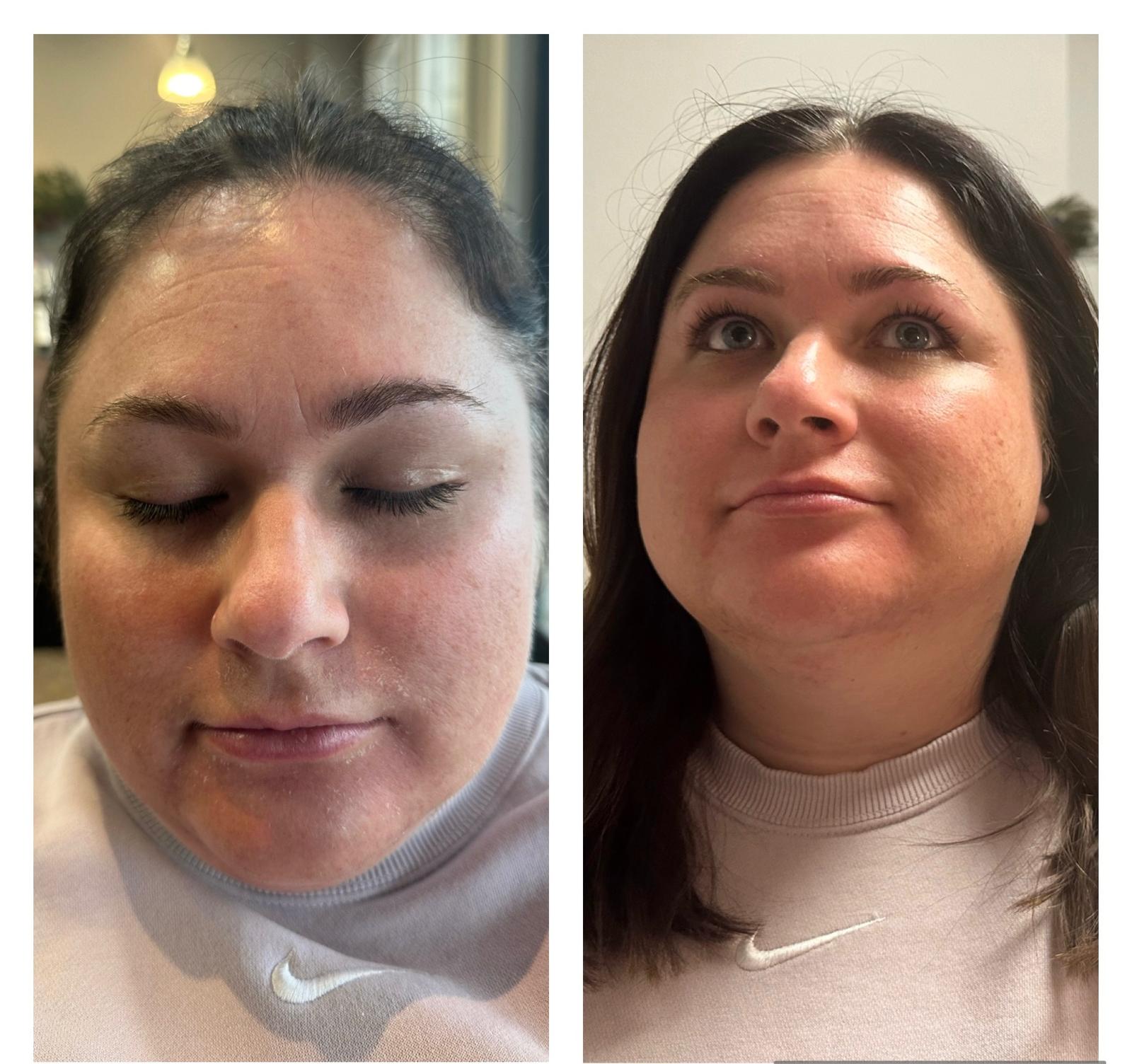 Before and after images of a woman showcasing the results of a nose job, highlighting her enhanced facial features.